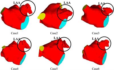 Numerical study of the risk of thrombosis in the left atrial appendage of chicken wing shape in atrial fibrillation